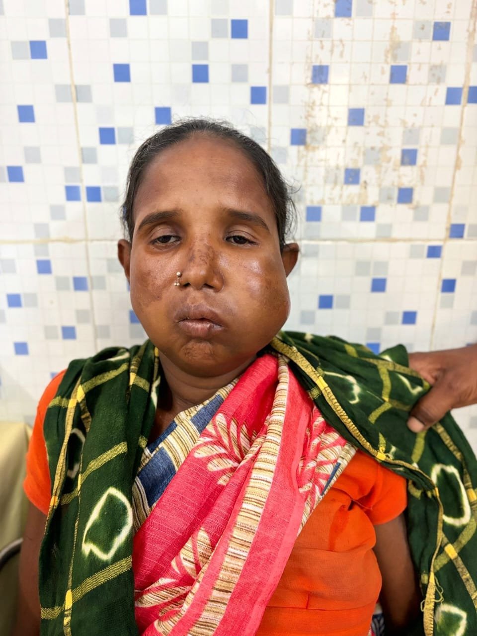 संजीवनी बना मेगा सुपर स्पेशलिटी हेल्थ कैंप   बुधरी मड़कम को प्रशासन की तत्परता से एम्स रायपुर में मिला नया जीवन