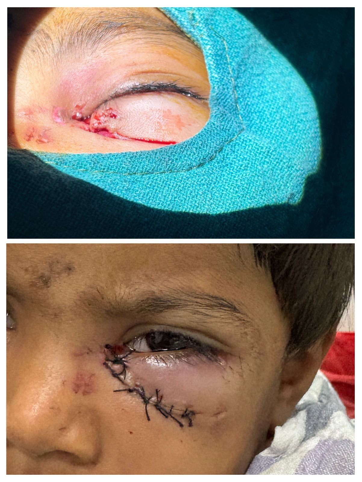 बिल्हा क्षेत्र के बटोरी गांव में आवारा कुत्ते के हमले में घायल दो मासूम बच्चों का सिम्स में सफल उपचार