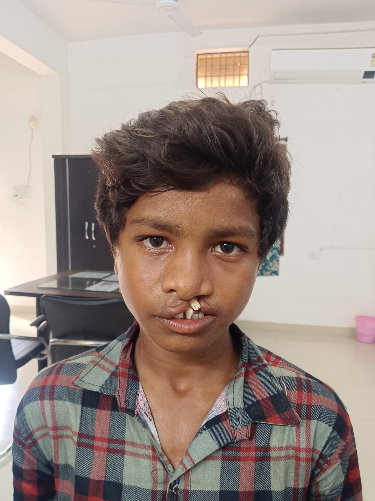 आरबीएसके के ‘चिरायु’ दल ने जन्मजात क्लेफ्ट लिप एवं पैलेट से पीड़ित बालक को दिलाई नई मुस्कान